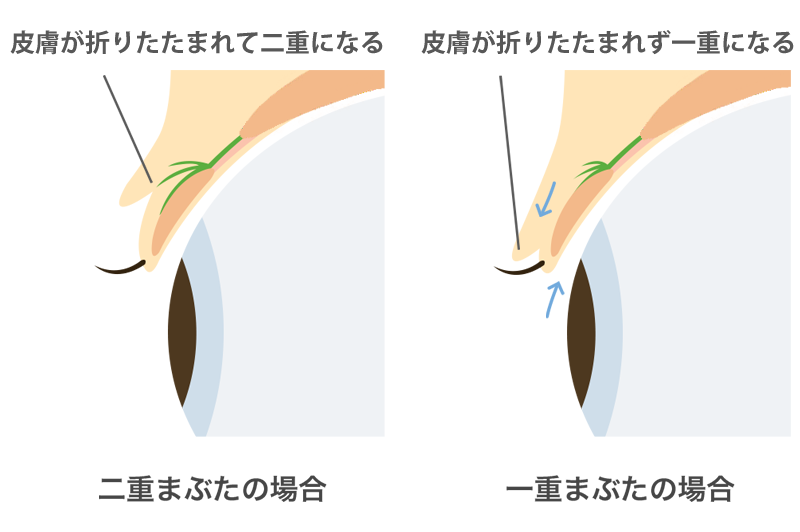 二重小切開法　手術方法01